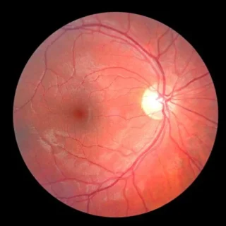 Glaucoma Diagnostics in Mumbai