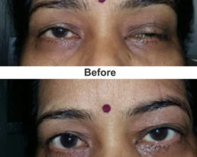 Oculo-Plasty Procedures in Mumbai