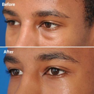 Eye Aesthetics Surgery in Mumbai